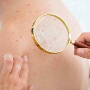 Atopic Dermatitis Eczema – Causes, Symptoms, and Treatments