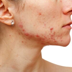 Know About The Symptoms Of Different Types Of Eczema